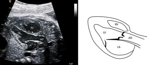 The Left Ventricular Outflow Tract View This View Shows The Left