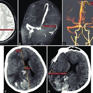 A Mri Brain T Weighted Gre Axial View Showing Right Parietal