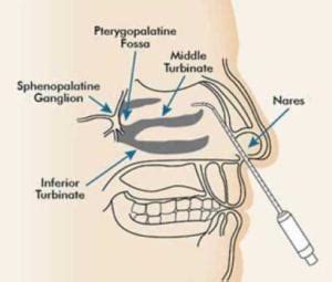 Chronic Migraines? Fix it with an SPG Block | Pony Express Dental