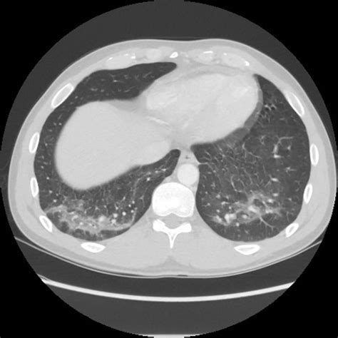 Pulmonary actinomycosis and marijuana vaping | BMJ Case Reports