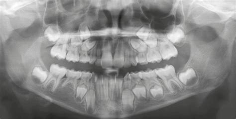 Scielo Brasil Orthodontic Management Of Bilateral Maxillary Canine