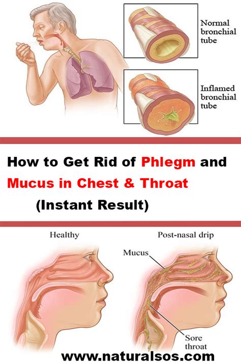 Causes Of Mucus In Throat