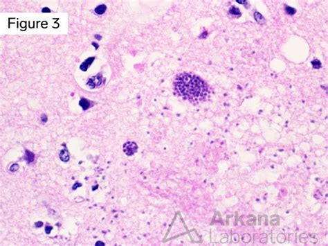 Toxoplasmosis In Cerebral And Brainstem Lesions Neuro Notes