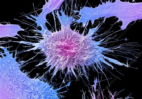 Cervical Cancer Cells SEM Stock Image C060 1665 Science Photo