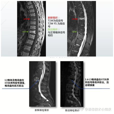 骨折影像诊断（2） 知乎