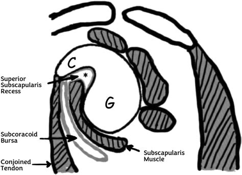 Can Subcoracoid Effusion Be A More Specific Finding For Subscapularis Tear Among Rotator Cuff