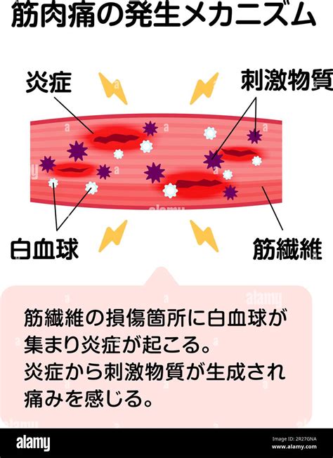 Mechanism of muscle soreness vector illustration Stock Vector Image ...