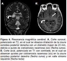 Neurocisticercosis Racemosa Sic Diagn Stico Orientado Por