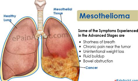 Mesothelioma Cancer: Symptoms of Mesothelioma Cancer - ReadNews