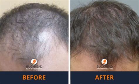 Male Hair Loss Treatment Neograft Prp Buckhead Hair Restoration