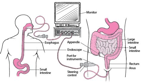 Figure Viewing The Digestive Tract With An Endoscope Merck Manuals