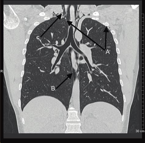 Coronal Reconstruction Image Ct Scan Of The Chest A Pneumothorax