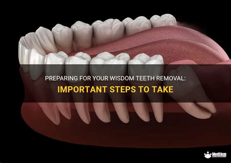 Preparing For Your Wisdom Teeth Removal Important Steps To Take Medshun