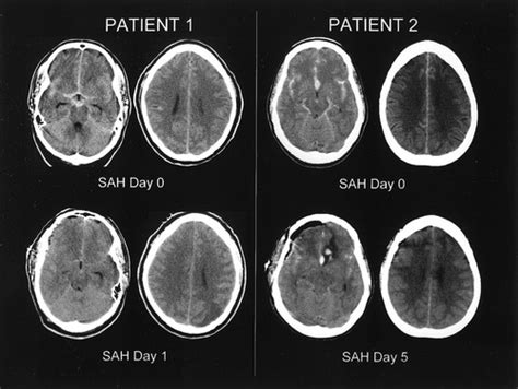 Edema Cerebrale Cos è E Quali Sono Le Cause