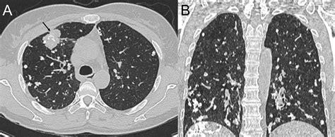 Frontiers Massive Calcified Epithelioid Hemangioendothelioma With