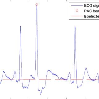 ECG signal with isoelectric line and P and T wave durations | Download ...