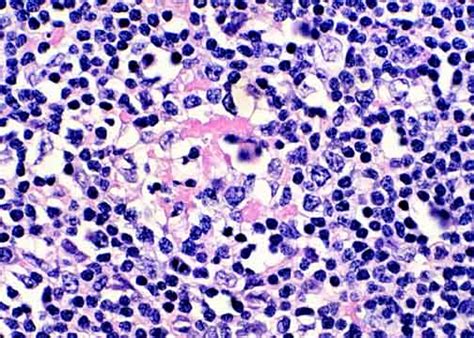 Peripheral T Cell Lymphomas Example 4B