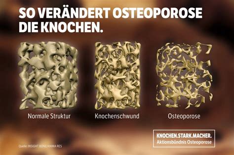 Langefeld Großes Interesse am Osteoporose Vortrag im Wiescheider Treff