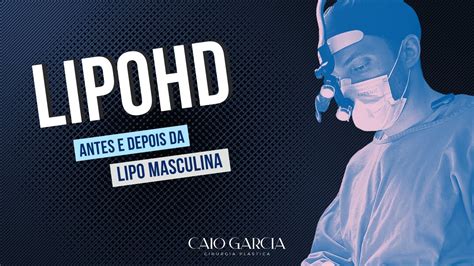 Cirurgia Plástica Lipo HD Como é o Antes e Depois da Lipo Masculina