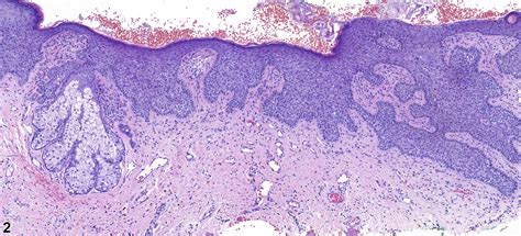 Cerebriform Congenital Scalp Mass JAAD Case Reports