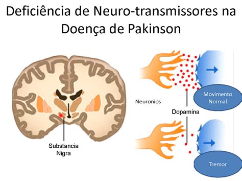 Doença de Parkinson e Disfunções Vesicais Dr Paulo Rodrigues