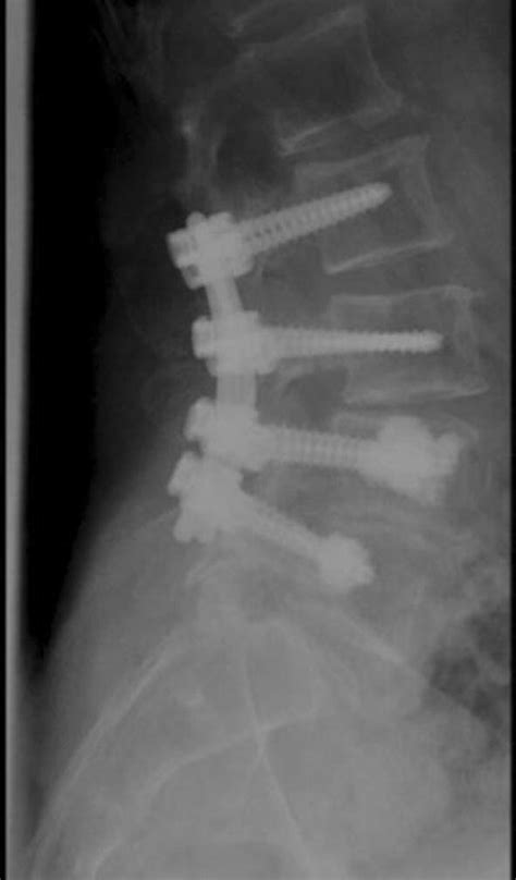 Extension Of The Posterior Fixation With Transpedicular Screws In L