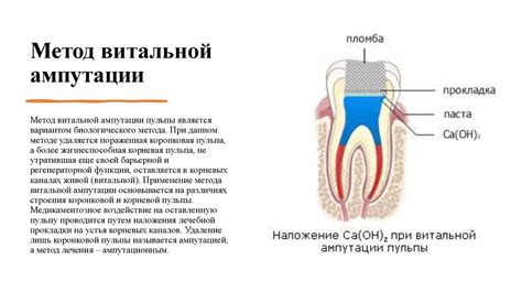 Пульпит. Классификации. Методы лечения - презентация онлайн