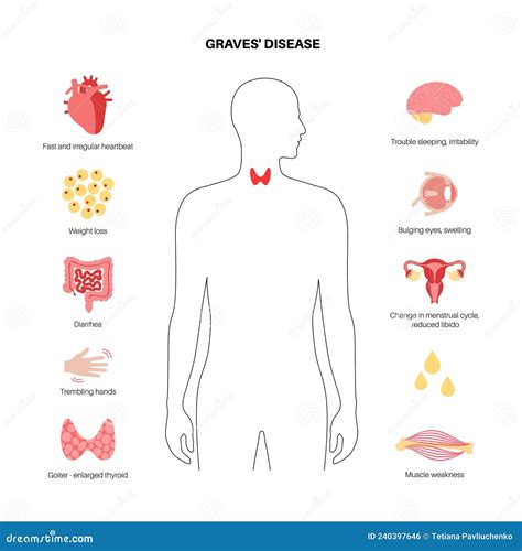 Hyperthyroidism Graves Disease Stock Illustration CartoonDealer