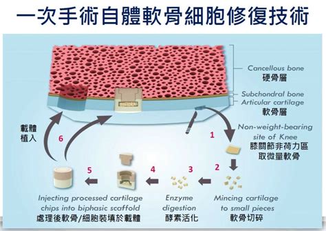 博晟生醫自體軟骨修補「愛膝康」 進軍中國市場 自由財經