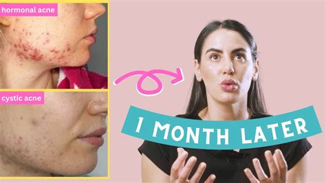 How I Cured My Adult Hormonal Cystic Acne No Accutane Or Birth Control