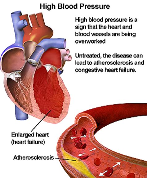 High Blood Pressure: Symptoms, Causes & Remedies | Study.com