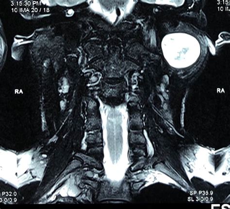 Internal Jugular Vein Thrombosis?