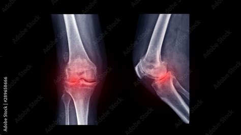 Film X Ray Knee Radiograph Show Rheumatoid Arthritis Disease Ra Knee