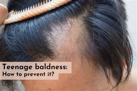 Teenage balding: how to prevent it? - SkinQure