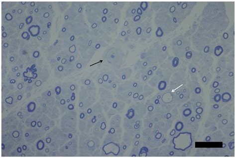 Nerve Biopsy From A Patient With Cidp Semi Thin Transverse Section