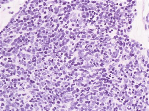 Pathology Outlines Thymoma Classification