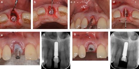 Hard And Initial Soft Tissue Grafting With Fabrication Of Emergence