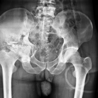 Axial CT scan demonstrates severe comminution of the right acetabulum ...