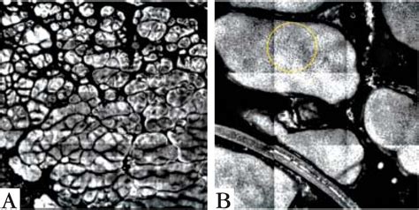 SciELO Brasil Genital Warts Comparing Clinical Findings To