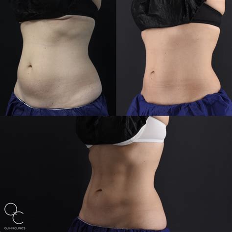 Emsculpt Neo At Quinn Clinics Transform Your Body Shape