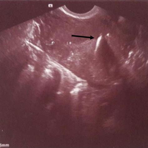 Transvaginal Ultrasound Intramyometrial Iud With A Fragmented Aspect