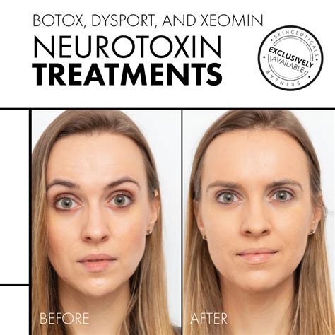 Botox Transformations Before After Secrets Unlocked