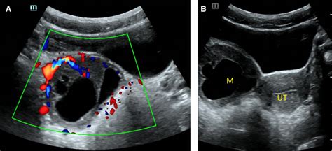 O Rads 5 Pathology Moderate Differentiated Sertoli Leydig Cell Tumor