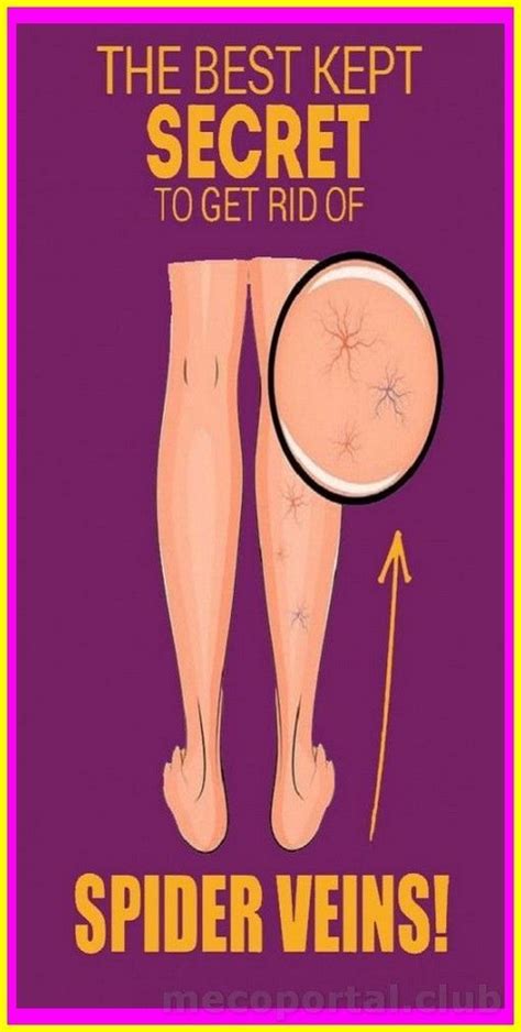 How To Get Rid Of Spider Veins Emedihealth Artofit