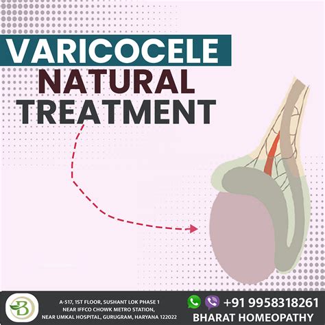 Homeopathic Treatment For Varicocele An Effective Solution For Symptom