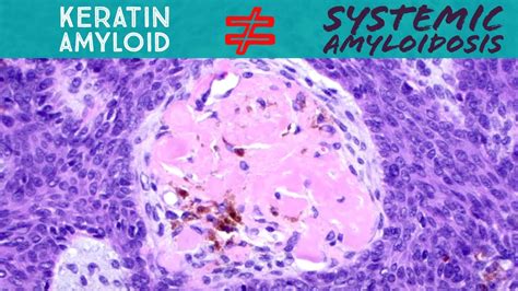 Keratin Amyloid Not Systemic Amyloidosis Light Chain Al Amyloid