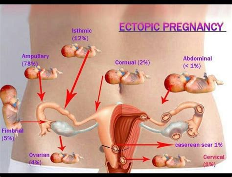 Ectopic Pregnancy Causes And Symptoms Symptoms Of Disease Hot Sex Picture