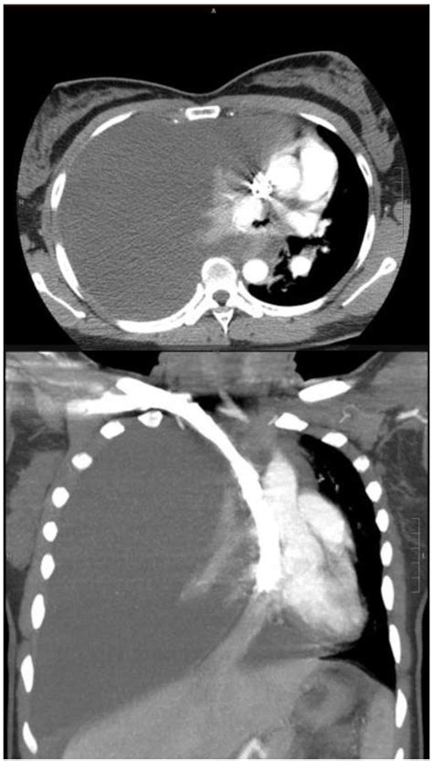 Tension Hydrothorax From Disseminated Endometriosis The Western