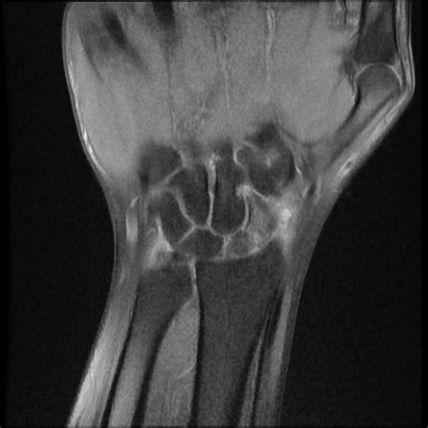 Scaphoid Fracture And Avascular Necrosis Image