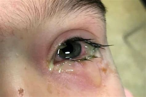 Bacterial Conjunctivitis